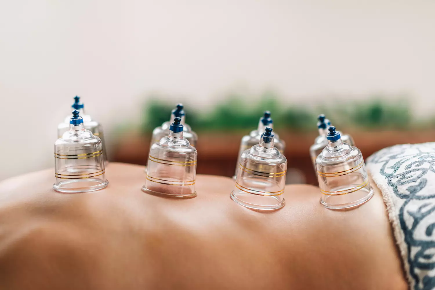 Hijama